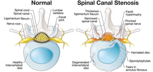 Illustration Showing Spinal Canal Stenosis Lumbar Vertebra Intervertebral Disc Herniated Stock Kép