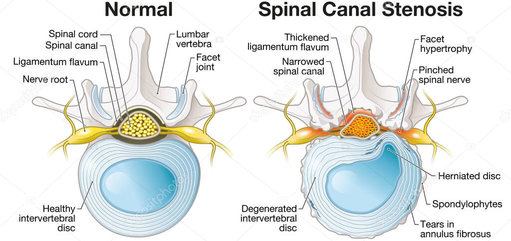 Illustration showing spinal canal stenosis lumbar vertebra with intervertebral disc and herniated nucleus pulposus