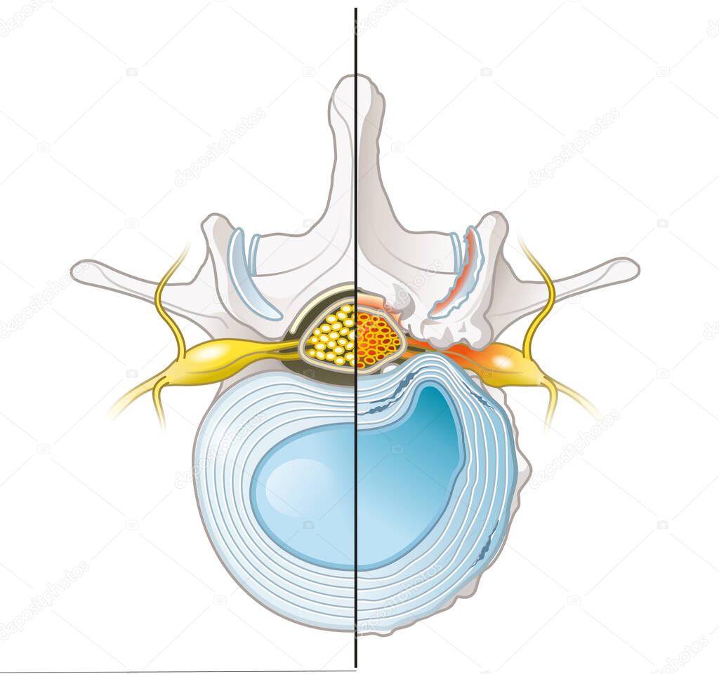 Illustration showing spinal canal stenosis lumbar vertebra with intervertebral disc and herniated nucleus pulposus