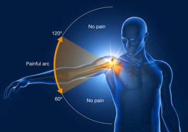 Illustration showing shoulder impingement, painfull arc, 3D illustration