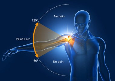 Illustration showing shoulder impingement, painfull arc, 3D illustration clipart