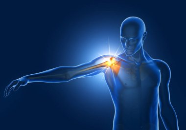 Illustration showing shoulder impingement, painfull arc, 3D illustration