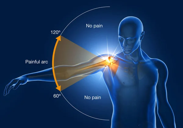 Illustration showing shoulder impingement, painfull arc, 3D illustration