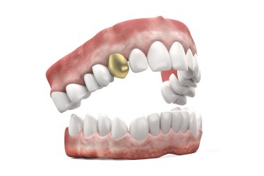Jaw with a golden tooth clipart