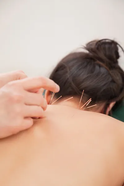 Acupuncture needles on back