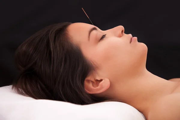 Acupuncture needle in the head — Stock Photo, Image