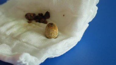 Safra kesesi laparoskopisi ameliyatından sonra sıkıştırılmış safra taşı alındı. Karında kolesistektomi. Karaciğer yetmezliği, bilirubin safra yolu tıkanıklığı. Safra tıkanıklığı.