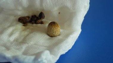 Safra kesesi laparoskopisi ameliyatından sonra sıkıştırılmış safra taşı alındı. Karında kolesistektomi. Karaciğer yetmezliği, bilirubin safra yolu tıkanıklığı. Safra tıkanıklığı.