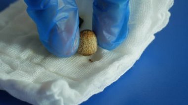 Safra kesesi laparoskopisi ameliyatından sonra sıkıştırılmış safra taşı alındı. Karında kolesistektomi. Karaciğer yetmezliği, bilirubin safra yolu tıkanıklığı. Safra tıkanıklığı.