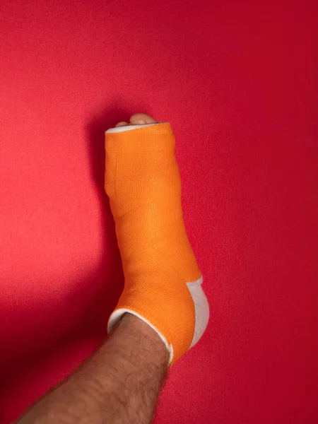 Foot Broken Toe Bone Orange Fiberglass Cast Pink Background Injured — Stock Photo, Image