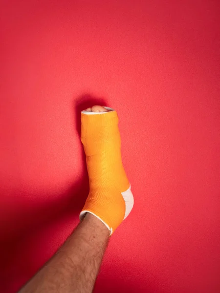 Ноги Розбитою Кісткою Пальця Помаранчевому Скловолокні Відливали Рожевий Фон Поранений — стокове фото