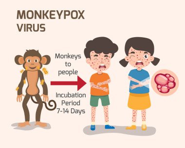 Maymun çiçeği virüsü, isilik olmuş insan vücudu. Hastalığın belirtileri, şişmiş lenf düğümleri, vektör illüstrasyonu..