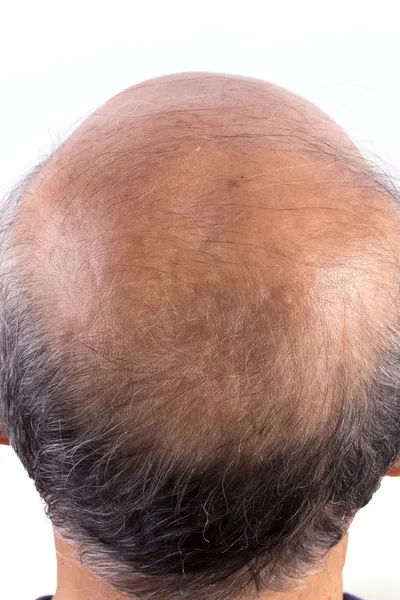 Perdita di capelli uomo calvo — Foto Stock