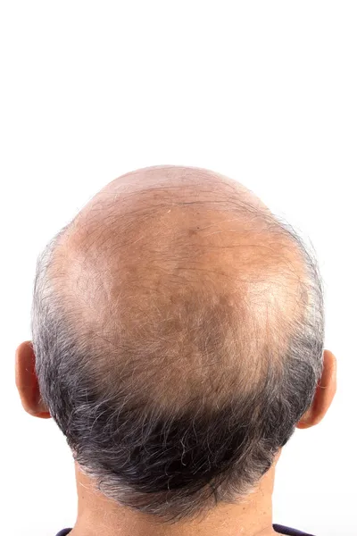 Pérdida de cabello hombre calvo — Foto de Stock