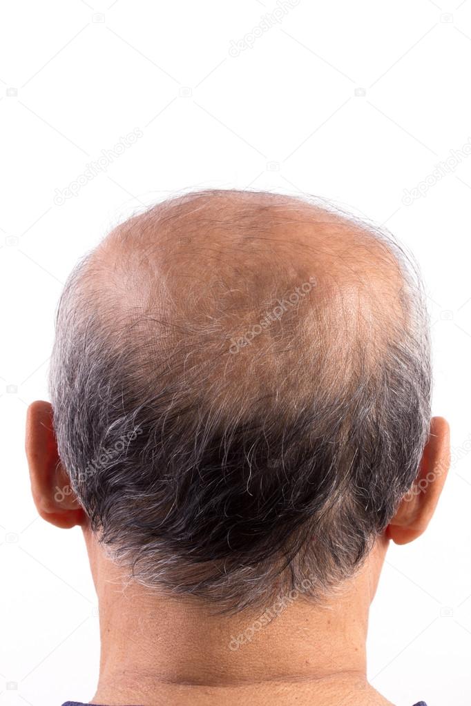 Perda de cabelo homem careca — Foto © tuthelens #34343129