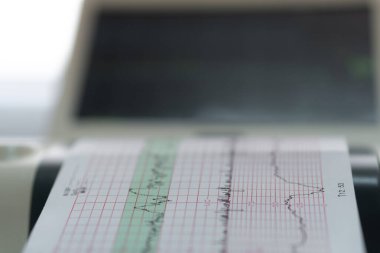 Elektronik Kardiyografi Makinesi rahmin fetal kalp kasılmalarını izliyor. Hamilelik sırasında doğum koğuşunda elektrokardiyogram çıktı. Tıbbi Teşhis Ekipmanı