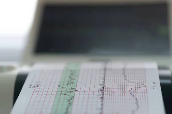 Elektroniczna Kardiotokografia Maszyna monitorująca skurcze serca płodu macicy. Drukowanie raportu kardiograficznego Wyjście elektrokardiogramu na oddziale pracy w czasie ciąży. Medyczny sprzęt diagnostyczny — Zdjęcie stockowe