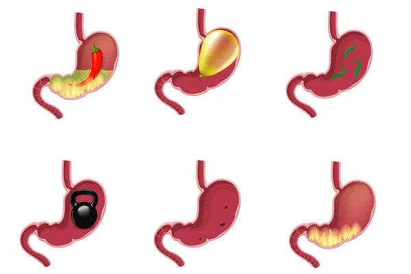 Maladies de l'estomac ensemble — Image vectorielle