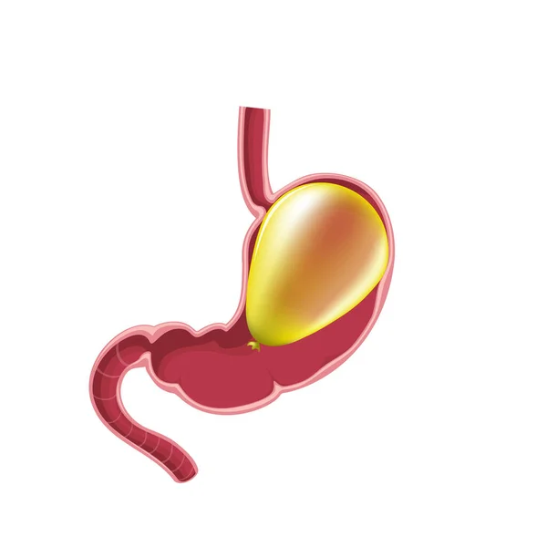 Γαστρικό μπαλόνι στομάχι — Διανυσματικό Αρχείο