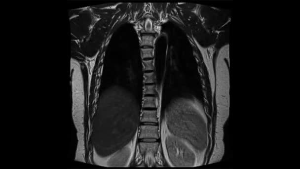 Göğüs Röntgeni Mri Animasyonu Nsan Ciğerleri Göğüs Görüntüleme — Stok video