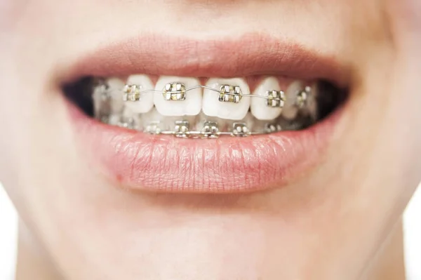 Dental Concept Braces Upper Lower Jaw Teenager Teeth Look Braces — Foto de Stock
