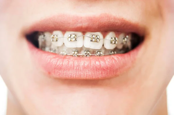 Dental Concept Braces Upper Lower Jaw Teenager Teeth Look Braces Stock Photo