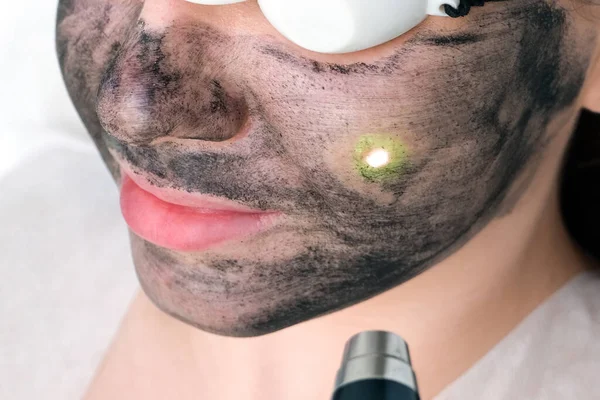 Peeling Węglowy Twarzy Młodej Pięknej Kobiety Odnowa Skóry Punkt Laserowy — Zdjęcie stockowe