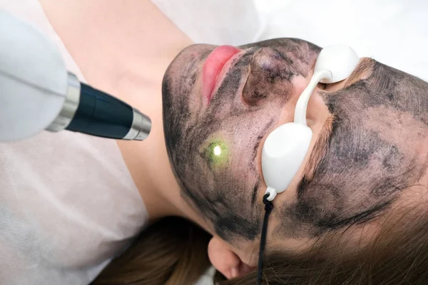 Carbon peeling of the face of a young beautiful woman. Peeling skin renewal. laser point on the face.