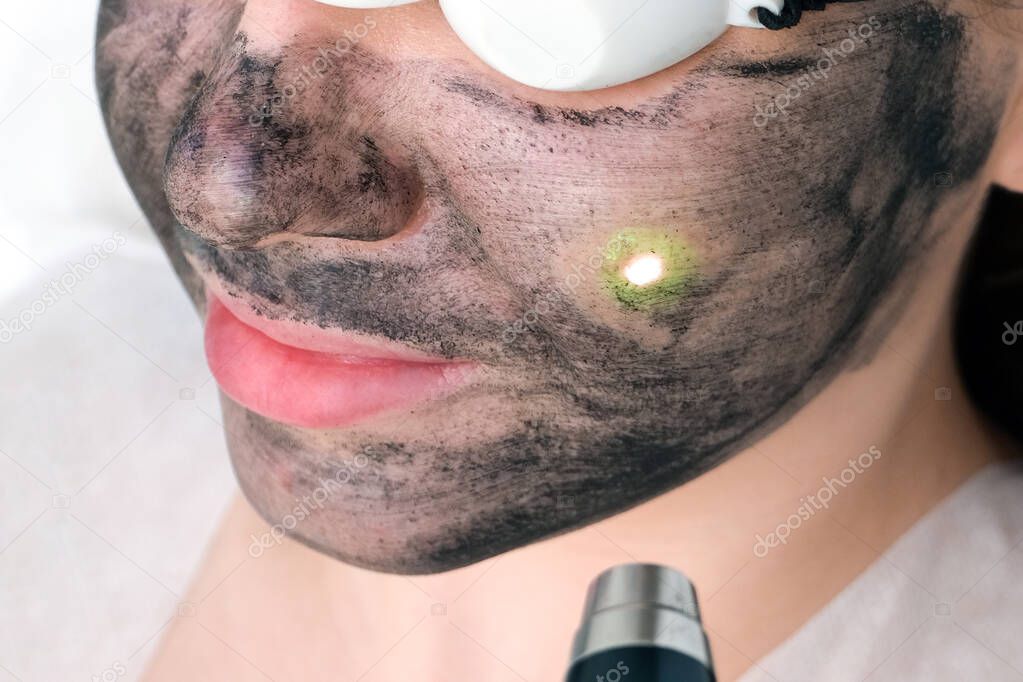 Carbon peeling of the face of a young beautiful woman. Peeling skin renewal. laser point on the face.