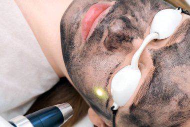 Genç ve güzel bir kadının yüzünün karbonu soyulmuş. Cilt yenileme. Yüzünde lazer noktası var..