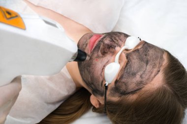 Genç ve güzel bir kadının yüzünün karbonu soyulmuş. Cilt yenileme. Yüzünde lazer noktası var..