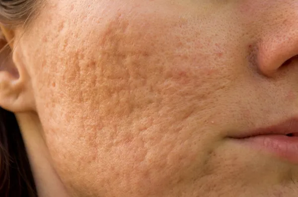 Acne scars — Stock Photo, Image