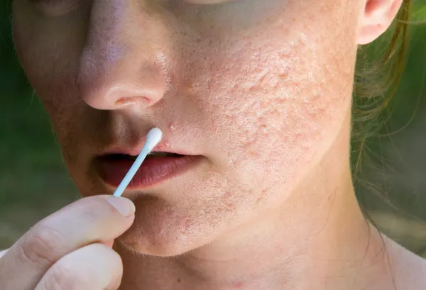 sivilce ve akne izleri