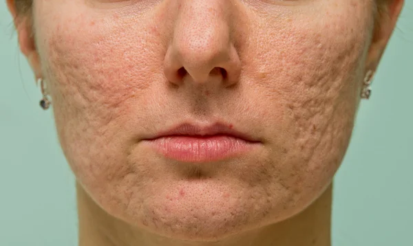 Problematic skin — Stock Photo, Image