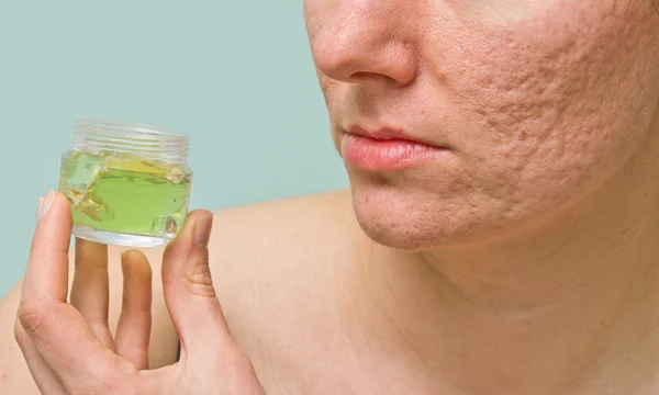 Problematic skin treatment — Stock Photo, Image