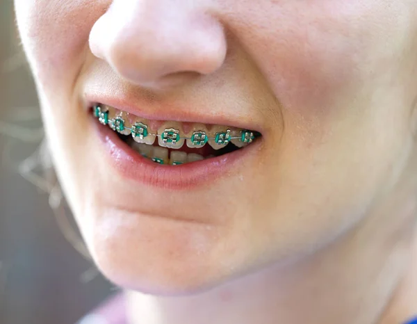 Close up of teenage girl\'s teeth with blue metal braces. Correction of bite. Dental care concept