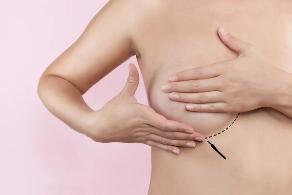 Breast augmentation — Stock Photo, Image