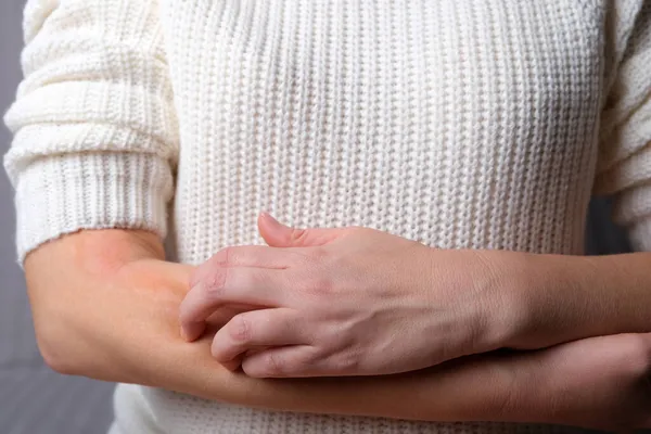 若い女性はかゆみから手を引っ掻いている アレルギー性皮膚炎 皮膚疾患の白斑 神経皮膚炎の病気 湿疹やウールアレルギー性発疹 ストックフォト
