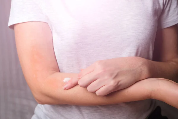 Wanita Muda Mengolesi Tangannya Dengan Krim Dermatitis Gatal Dermatitis Alergi Stok Gambar
