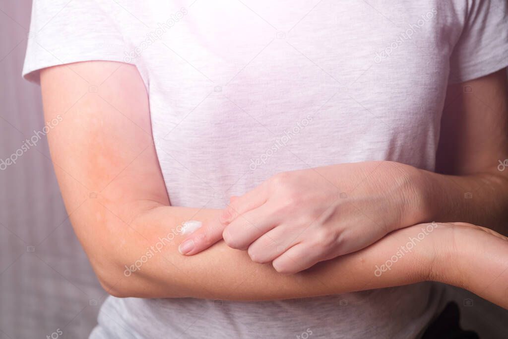 Young woman smears her hands with anti-itch dermatitis cream. Allergic dermatitis. Skin disease vitiligo. Neurodermatitis disease, eczema or allergy rash. Healthcare and Medical