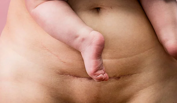 剖宫产后的女性腹部 术后刀伤 免版税图库图片