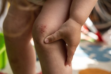 Bebek, asfalta düşmekten kaynaklanan yaralarda bulunan elini dikkatlice tırmaladı. Todler 'ın düştüğü ilk yara. Güneşli bir havada çekilmiş diz masajı.