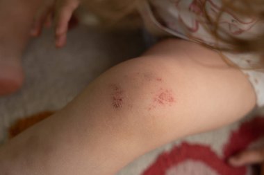 Çocuğun dizinde bir çizik var, asfalta düşmekten kaynaklanan yaralarda, bebeğin ilk yaralanması, kırık diz, güneşli bir havada çekilmiş fotoğraflar.