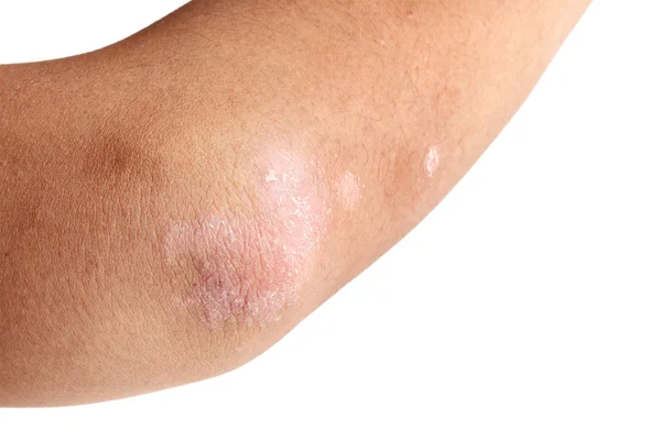 Psoriasis på arm — Stockfoto