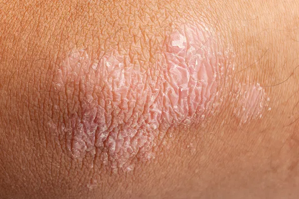 Psoriasis on elbow skin — Stock Photo, Image