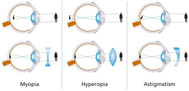 görme kusurları - miyopi, hipermetropi ve astigmat