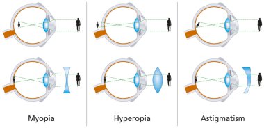 Vision Defects - Myopia, Hyperopia And Astigmatism clipart