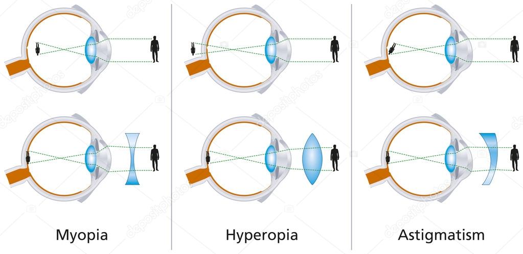 hipermetropie miopie astigmatism