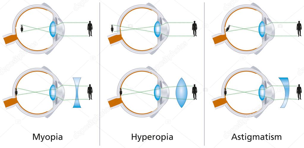 hyperopia több mint 8 dioptria