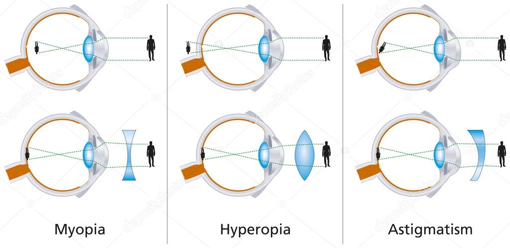 Vision Defects - Myopia, Hyperopia And Astigmatism